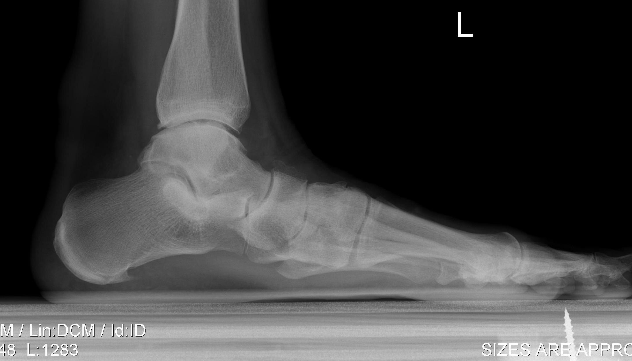 Midfoot OA Planovalgus